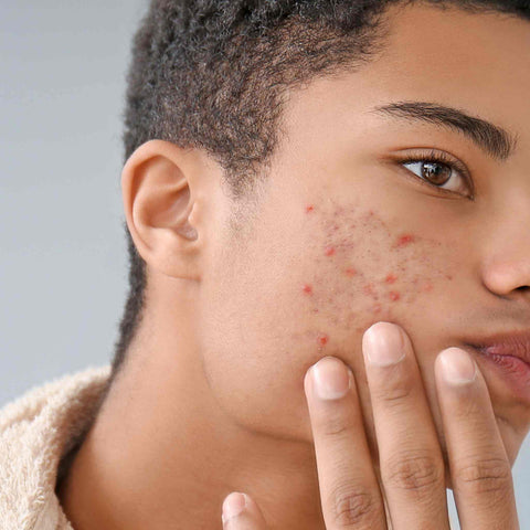 Acneic skin