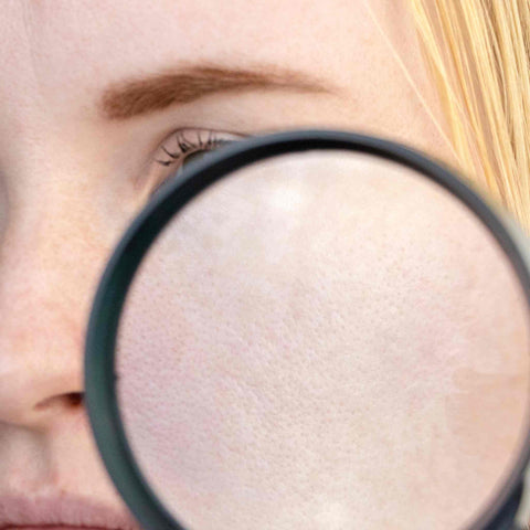 Enlarged Pores