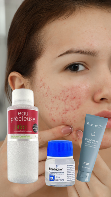 Woman with acne-prone skin holding skincare products including 'eau precieuse, hexomedine and face reality acnemed