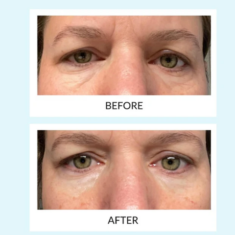 Talika eye patch before and after puffy