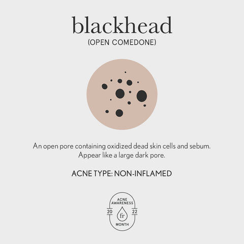 Blackhead acne illustration (Open Comedone)