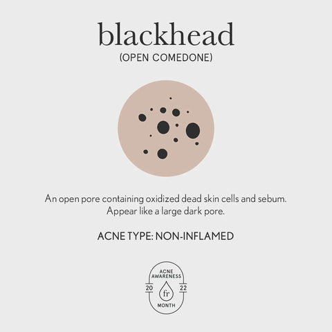 Blackhead acne illustration (Open Comedone)