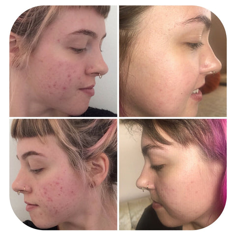 How to clear your acne now and learn how to stay clear.