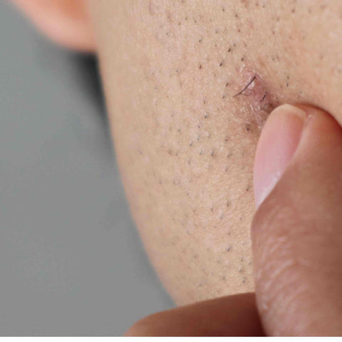 Ingrown Hair