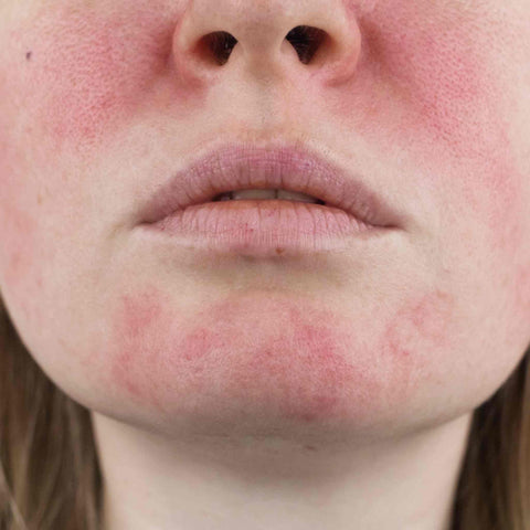 Rosacea and Acne rosacea