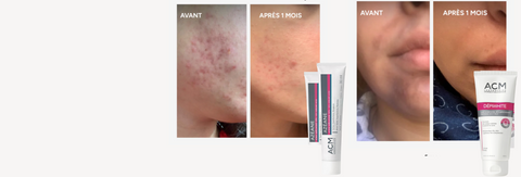 acne pigmentation