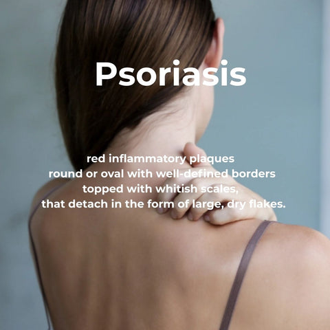 Woman with scratching her shoulder with red inflammatory plaque