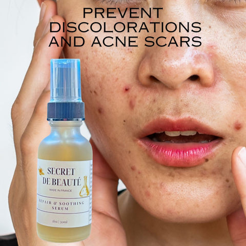 Prevent acne scars and discolorations with secret de beaute